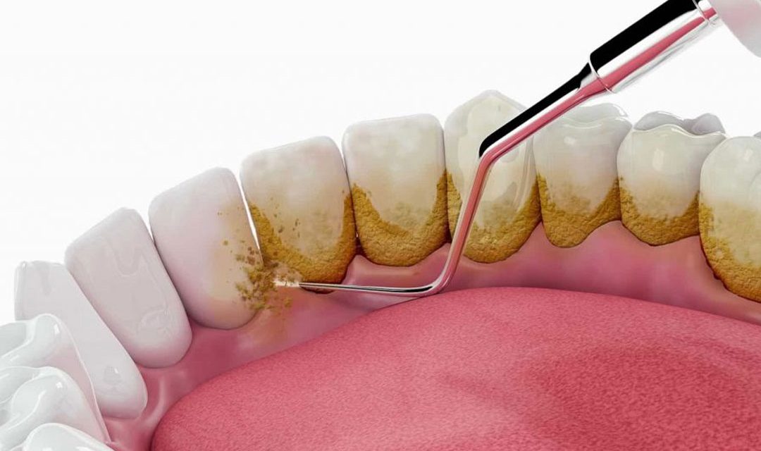 Perawatan Gigi Scaling Untuk Membersihkan Karang