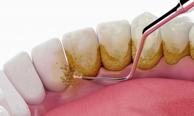 Perawatan Gigi Scaling Untuk Membersihkan Karang