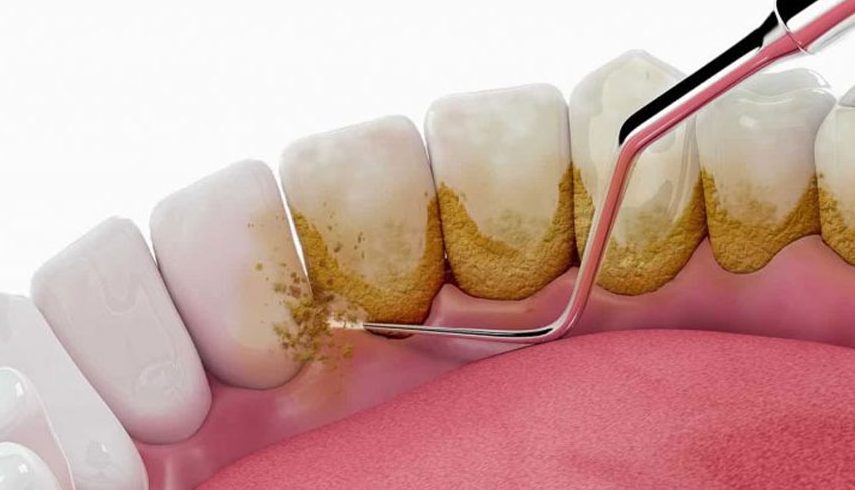 Perawatan Gigi Scaling Untuk Membersihkan Karang