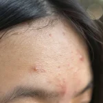 Cara Cepat Basmi Jerawat Dahi Yang Membandel