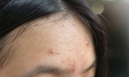 Cara Cepat Basmi Jerawat Dahi Yang Membandel