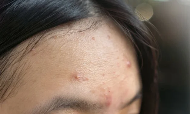 Cara Cepat Basmi Jerawat Dahi Yang Membandel