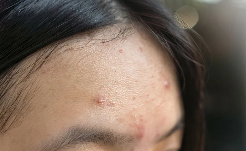 Cara Cepat Basmi Jerawat Dahi Yang Membandel