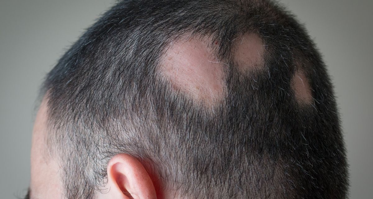 Penyebab Rambut Rontok Parah Dan Bikin Botak Usia Muda