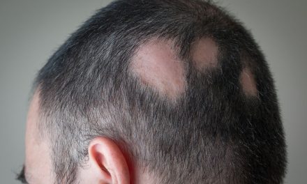 Penyebab Rambut Rontok Parah Dan Bikin Botak Usia Muda