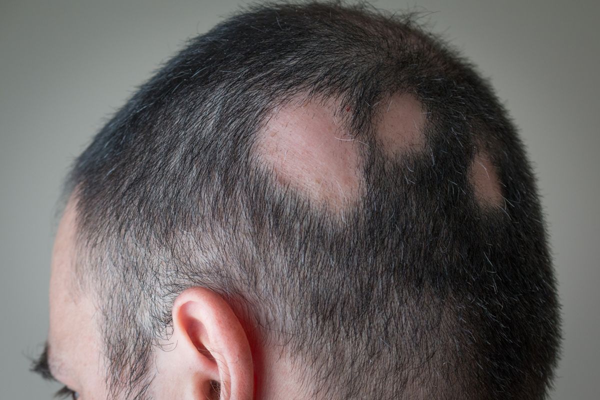 Penyebab Rambut Rontok Parah Dan Bikin Botak Usia Muda